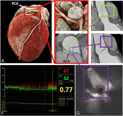 Hemodynamic Relevance of Anomalous Coronary Arteries Originating From the Opposite Sinus of Valsalva-In Search of the Evidence
